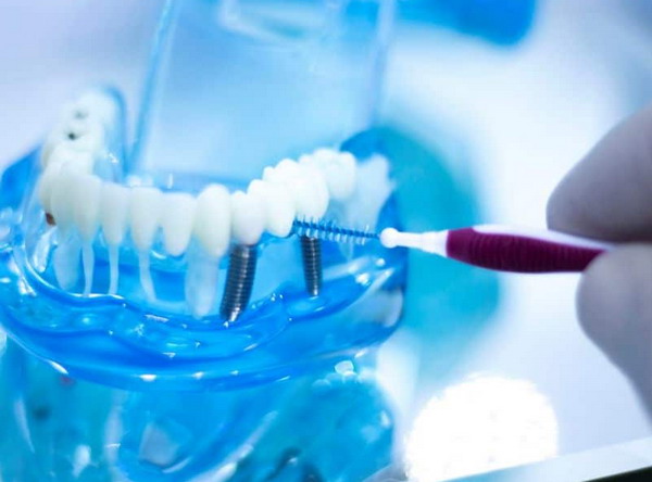 Dantų implantų priežiūra
